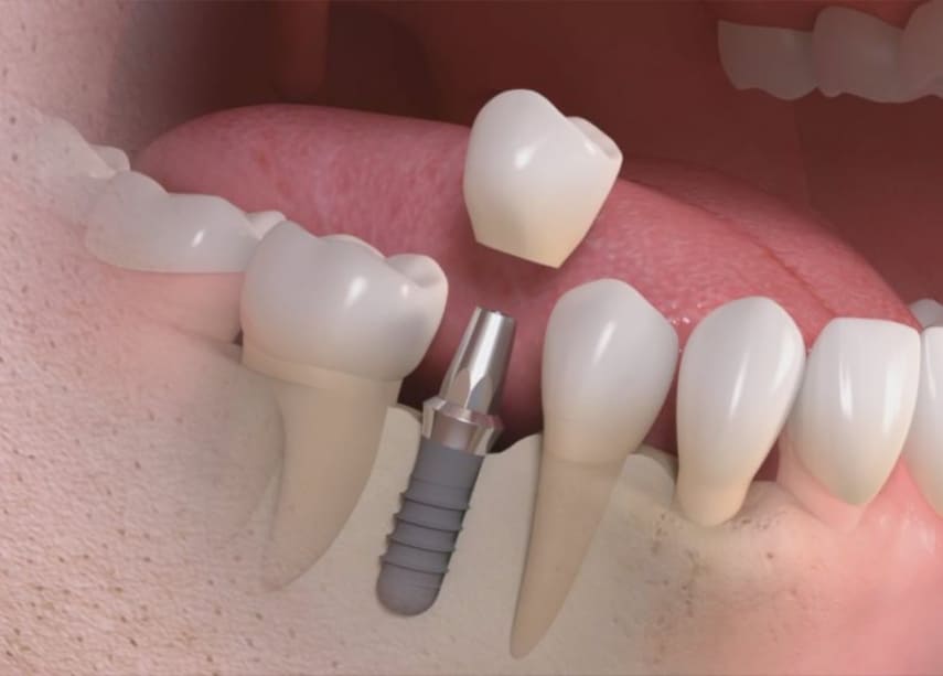 Studio New Smile - Implantologia - Studio dentistico a teramo