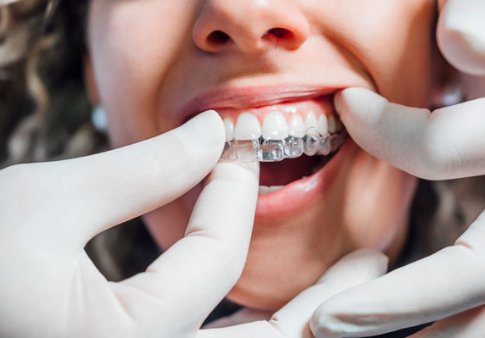 Studio New Smile - news - ortodonzia trasparente - studio dentistico a Teramo